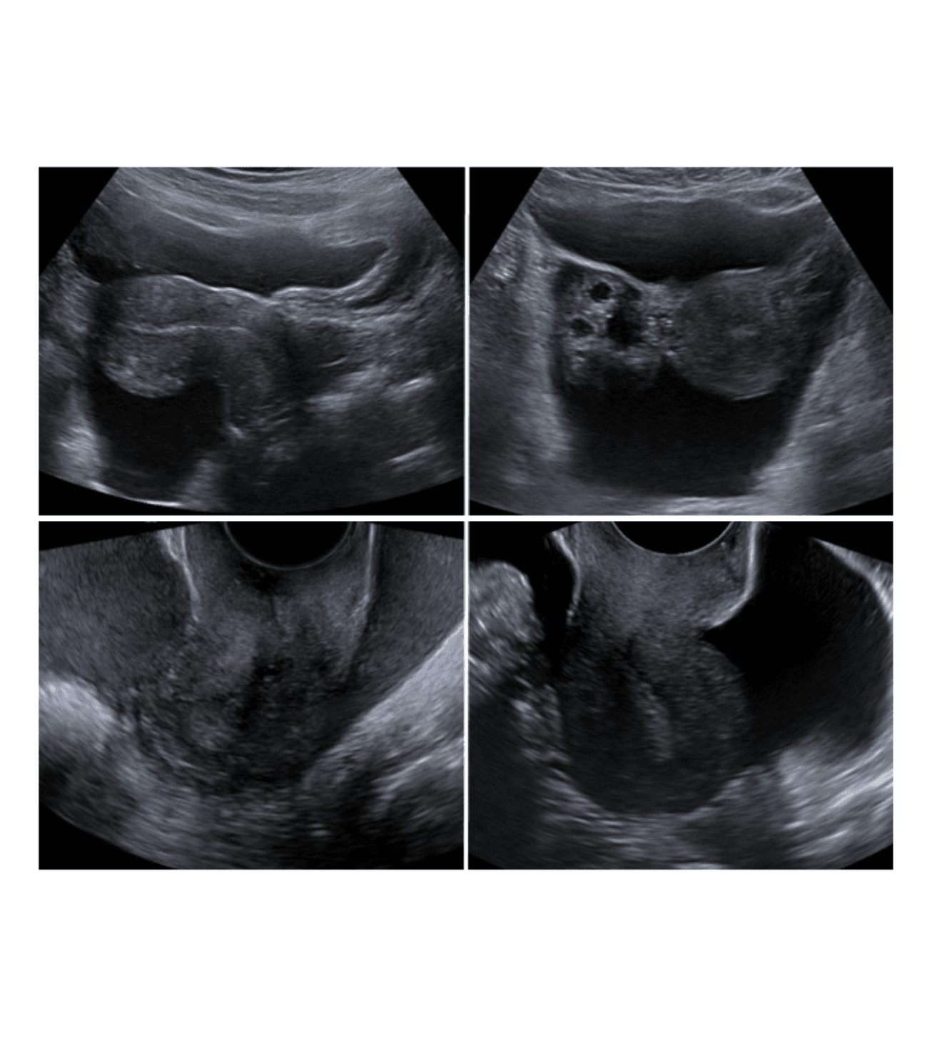 Irregular unilocular