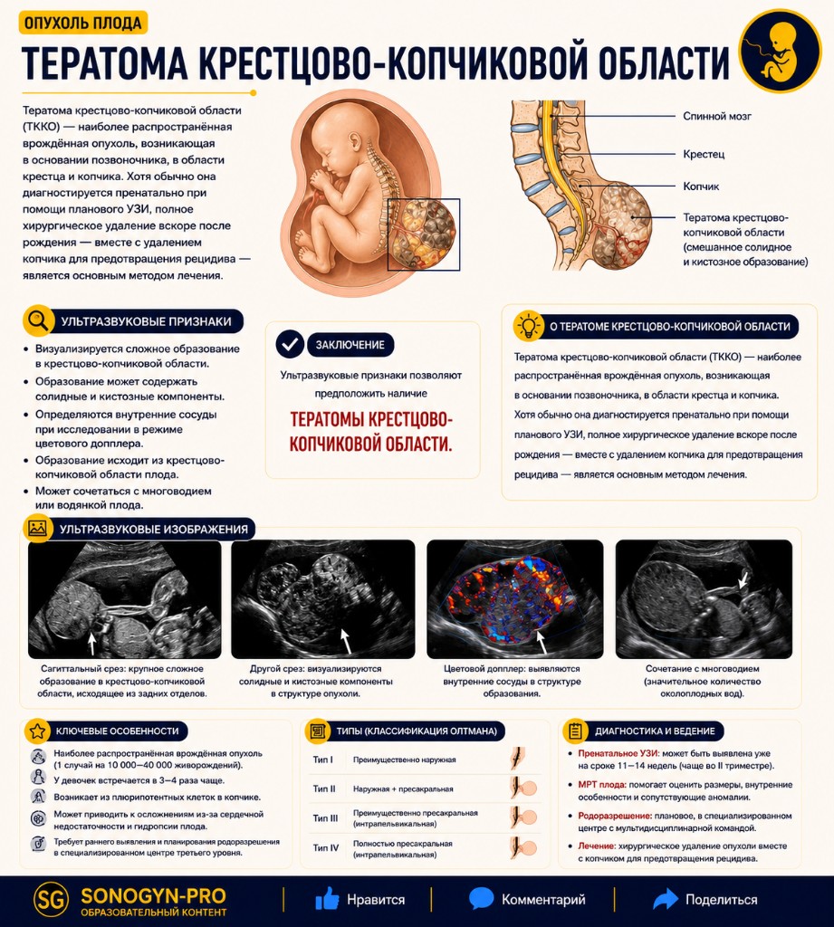 Тератома крестцово-копчиковой области