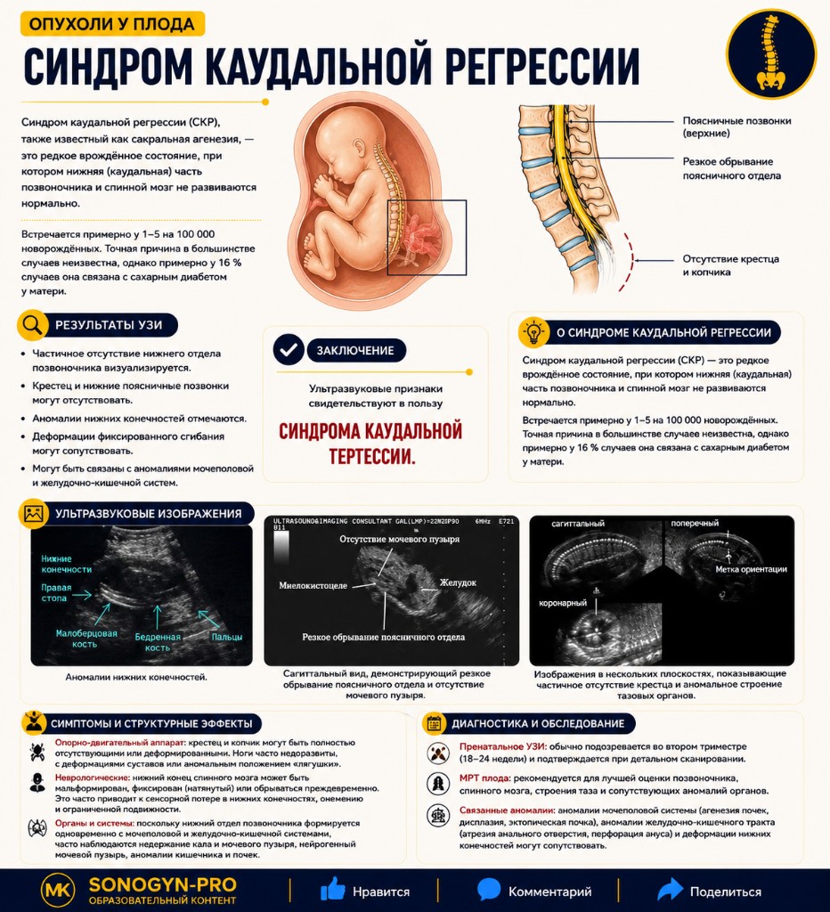 Паравертебральная опухоль