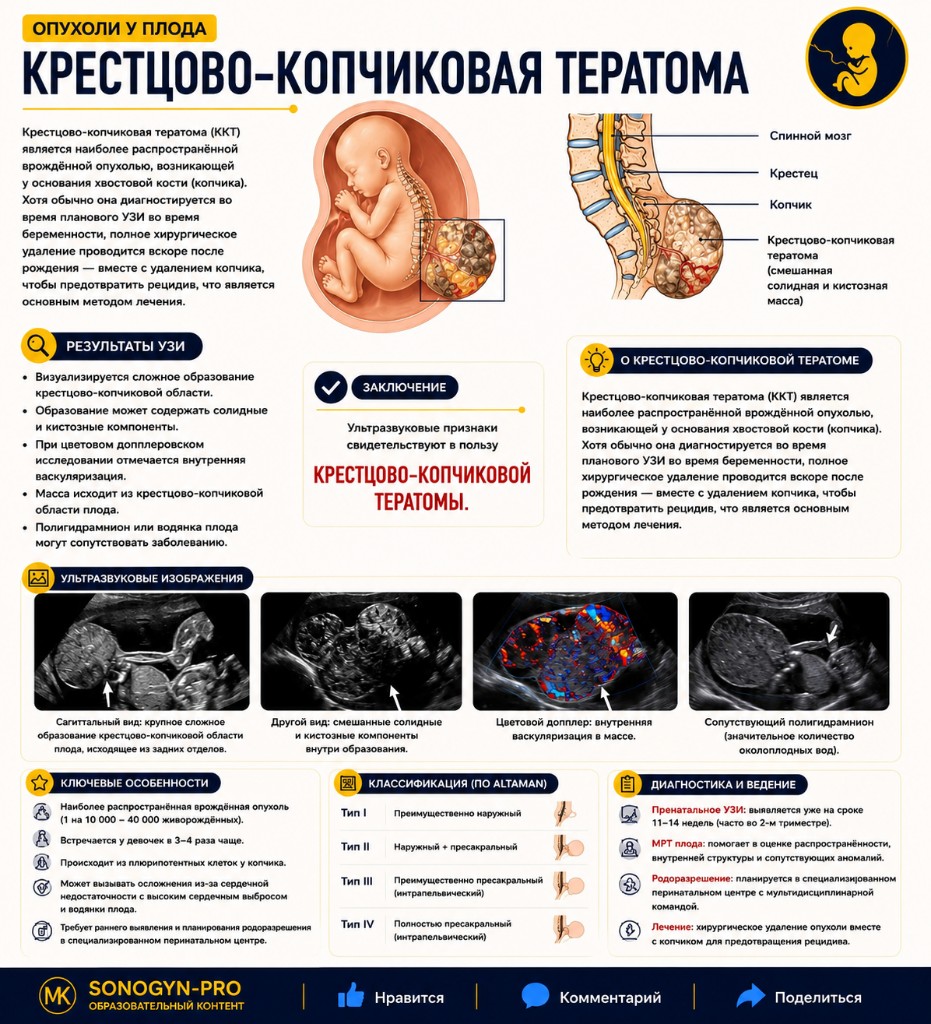Крестцово-копчиковая тератома (детальная оценка)