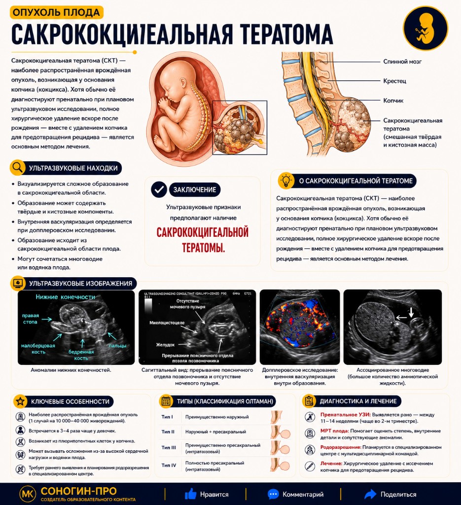 Крестцово-копчиковая тератома (протокол ведения)